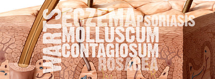 5 Skin Diseases Commonly Confused with Molluscum Contagiosum