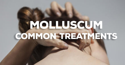 Common Treatments for Molluscum Contagiosum