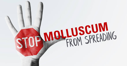 How to Stop Molluscum Contagiosum from Spreading to Other Parts of Your Body or to Family Members